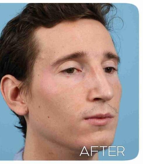 Rhinoplasty Before & After