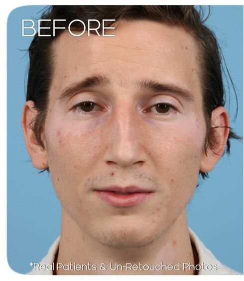 Rhinoplasty Before & After