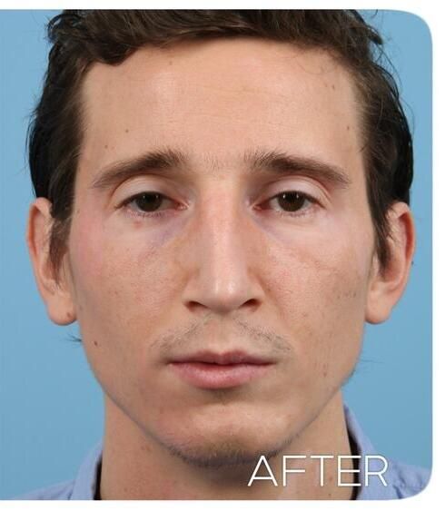 Rhinoplasty Before & After