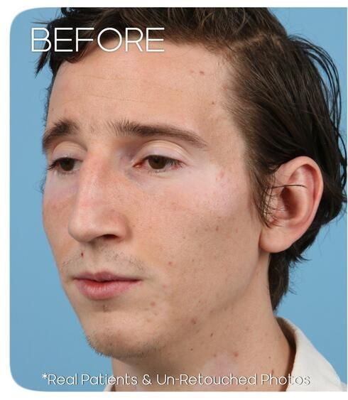 Rhinoplasty Before & After