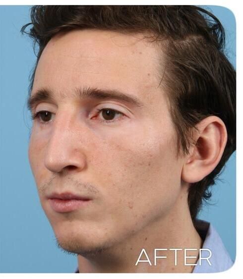 Rhinoplasty Before & After