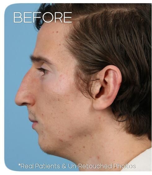 Rhinoplasty Before & After