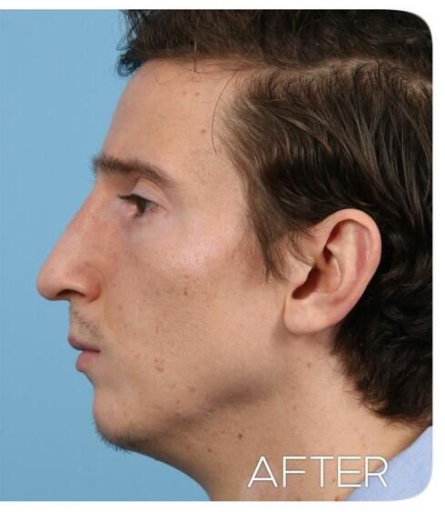 Rhinoplasty Before & After