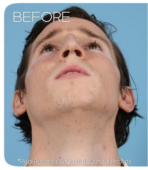 Rhinoplasty Before & After