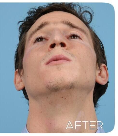 Rhinoplasty Before & After
