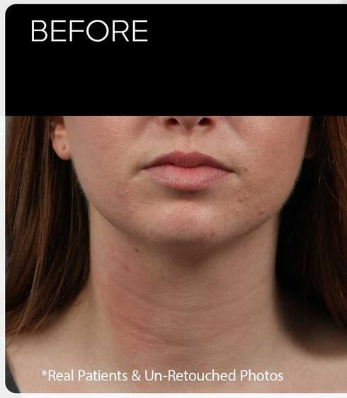 Facial Refinement Before & After