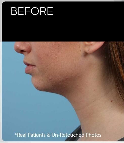 Facial Refinement Before & After