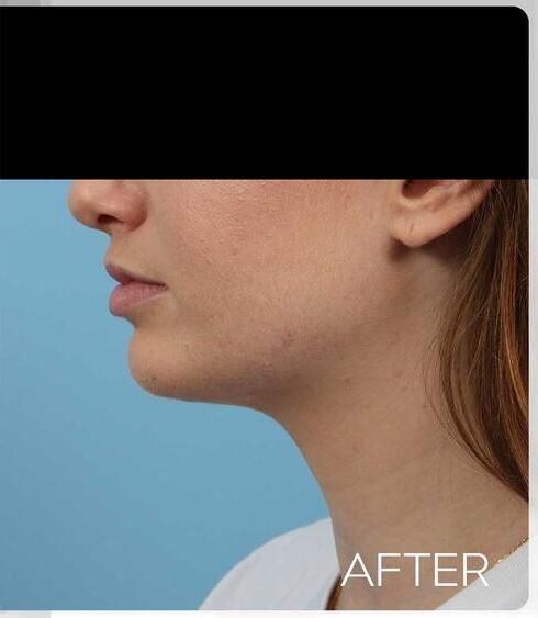Facial Refinement Before & After