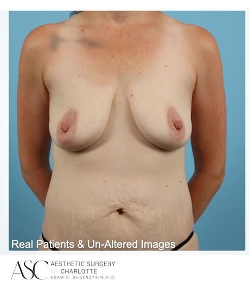 Breast Lift Before & After
