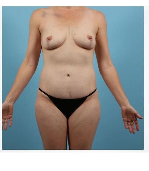 Breast Lift Before & After