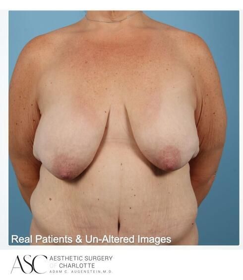 Breast Lift Before & After