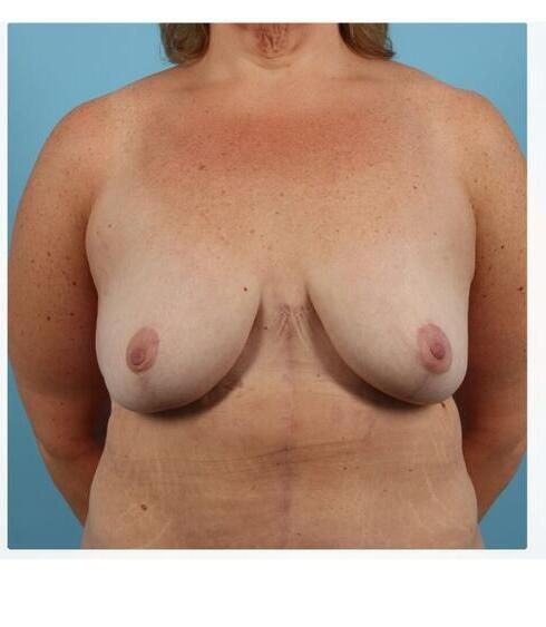 Breast Lift Before & After