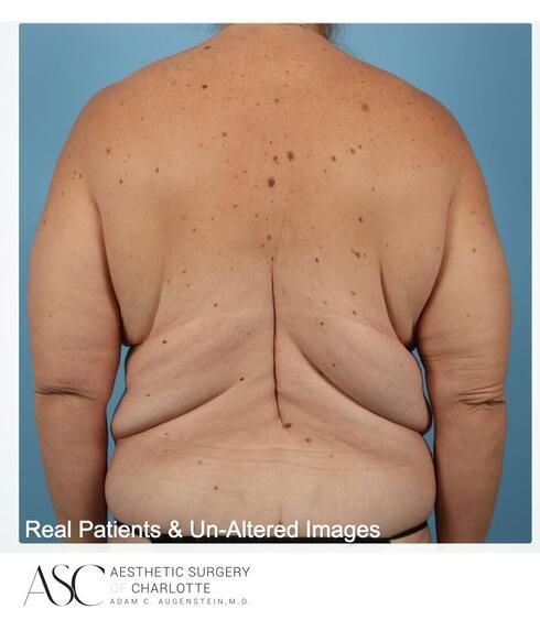 Breast Lift Before & After