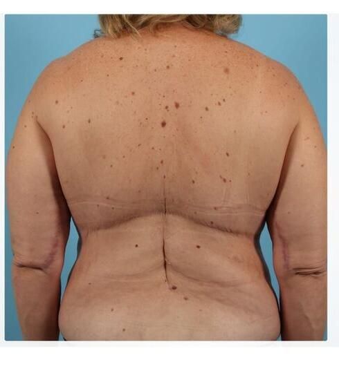 Breast Lift Before & After