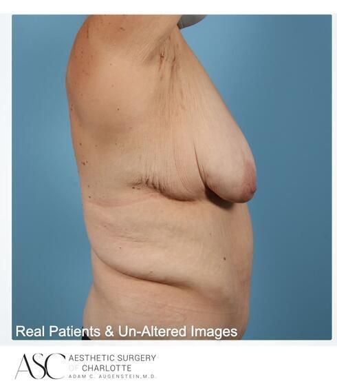 Breast Lift Before & After