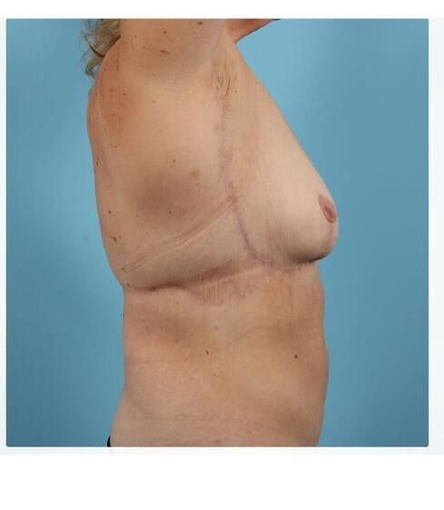 Breast Lift Before & After