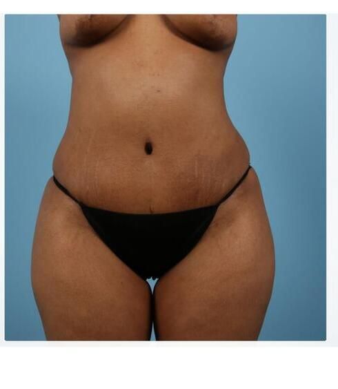 Breast Lift Before & After