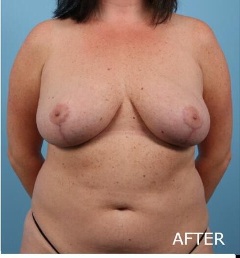 Breast Lift Before & After