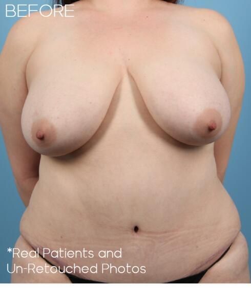 Breast Lift Before & After
