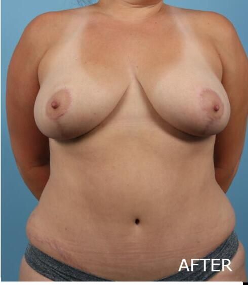 Breast Lift Before & After