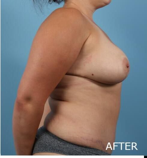 Breast Lift Before & After