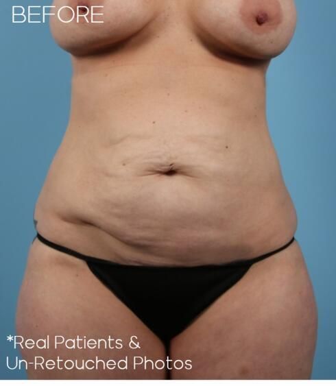 Breast Lift Before & After