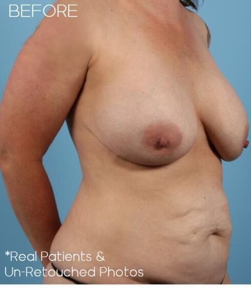 Breast Lift Before & After