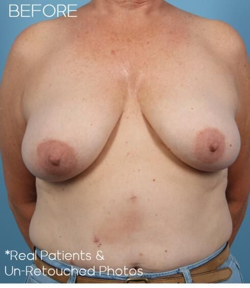 Breast Lift Before & After