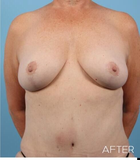 Breast Lift Before & After