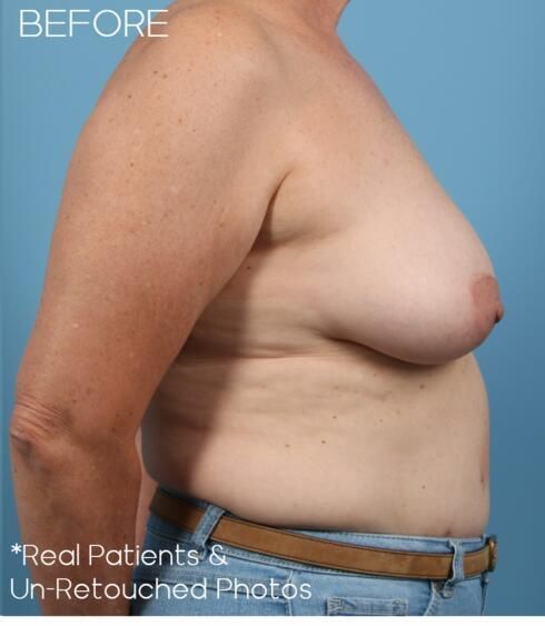 Breast Lift Before & After