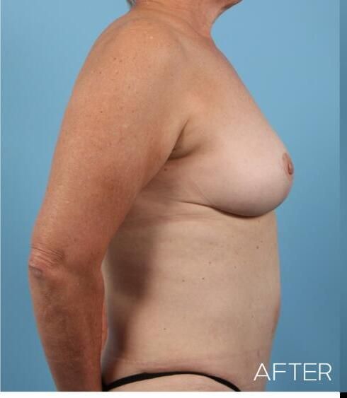 Breast Lift Before & After