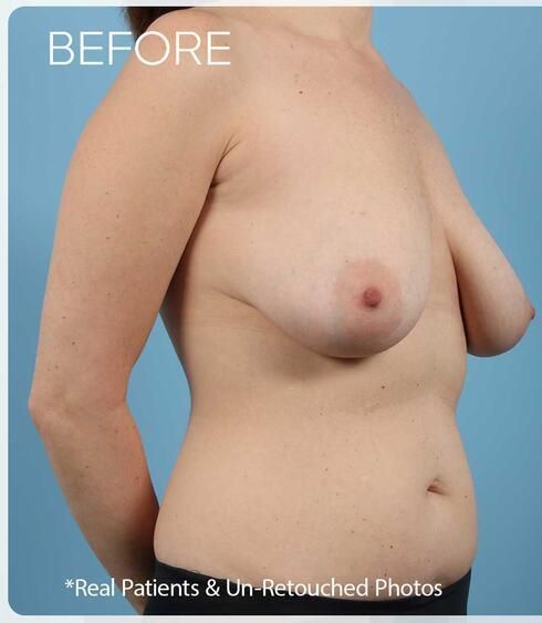 Breast Lift Before & After