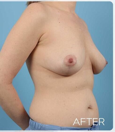 Breast Lift Before & After