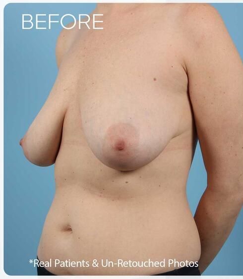 Breast Lift Before & After