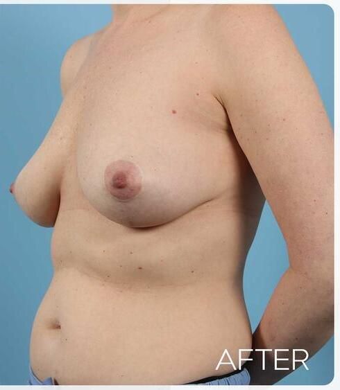 Breast Lift Before & After