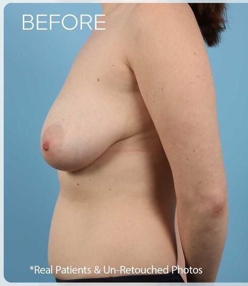 Breast Lift Before & After