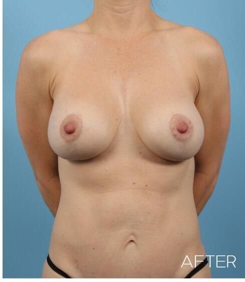 Breast Lift Before & After