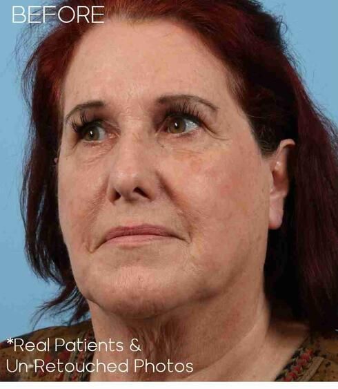 Necklift Before & After