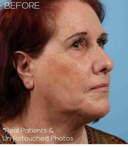 Necklift Before & After