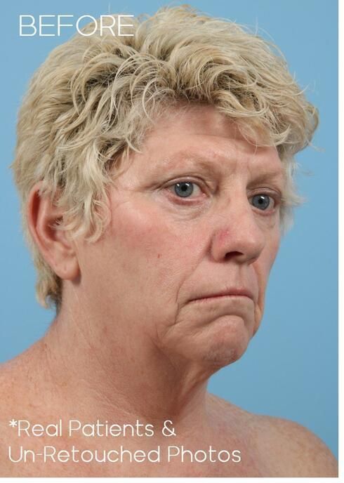 Necklift Before & After