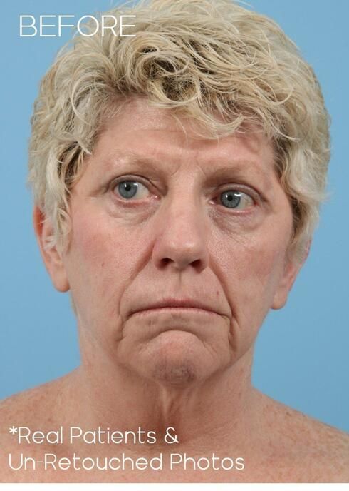 Facial Fat Grafting Before & After