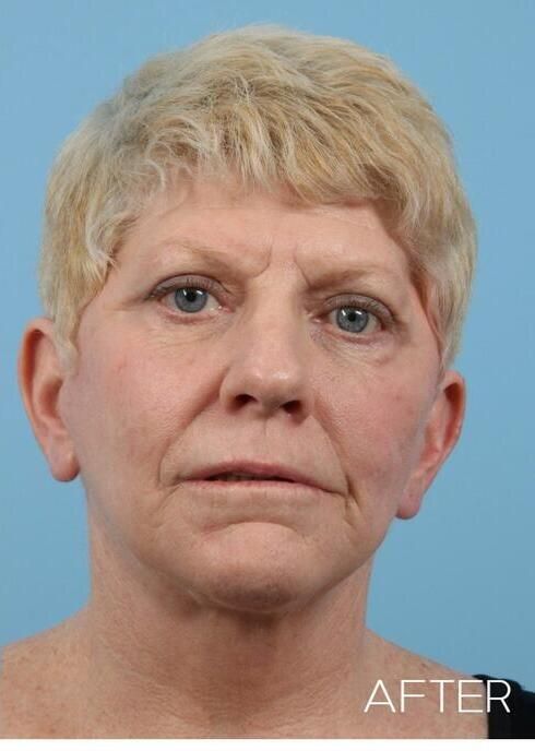 Facial Fat Grafting Before & After