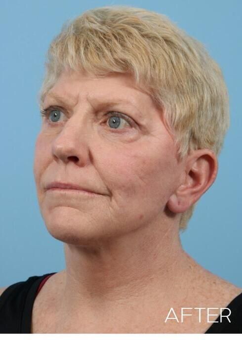 Facial Fat Grafting Before & After