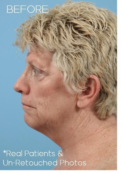 Facial Fat Grafting Before & After