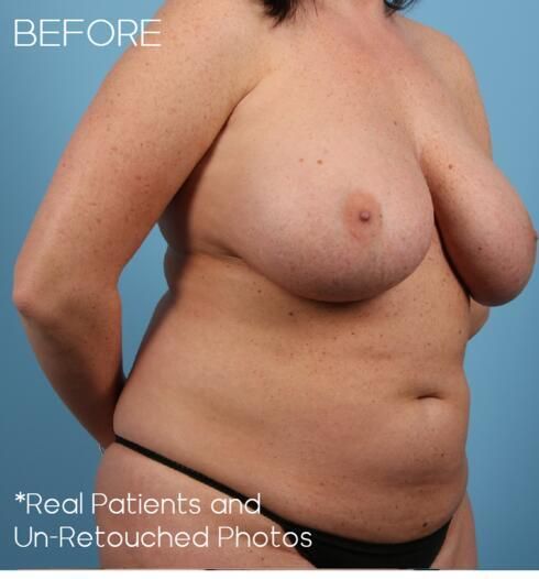 Breast Implant Removal Before & After