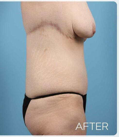 Post Massive Weight Loss Surgery Before & After