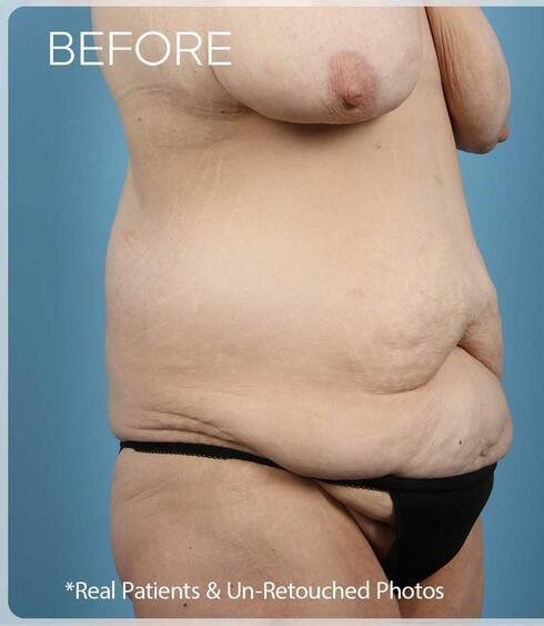 Post Massive Weight Loss Surgery Before & After