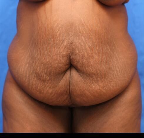 Post Massive Weight Loss Surgery Before & After