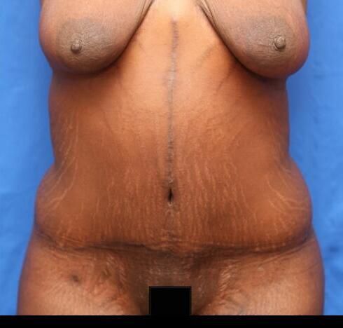 Post Massive Weight Loss Surgery Before & After