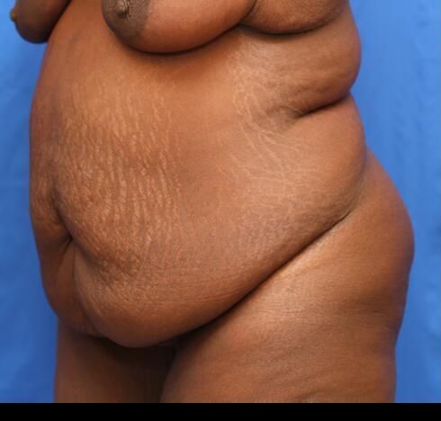 Post Massive Weight Loss Surgery Before & After